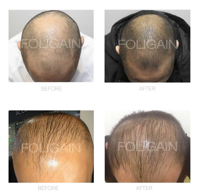FOLIGAIN® Minoxidil 5% Hair Regrowth Foam For Men 6 Month Supply